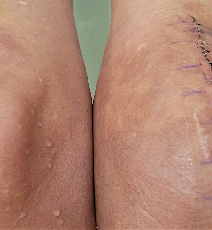 comparing-knees-post-op-full-knee-joint-replacemenT